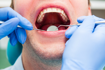 Close-up of male patient with open mouth during oral checkup at the dentist. Healthcare Dentist concept. Selective focusの写真素材