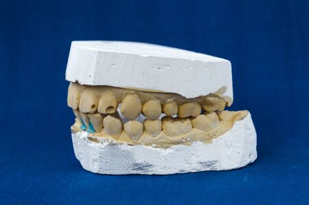 cast of the jaw on a blue background