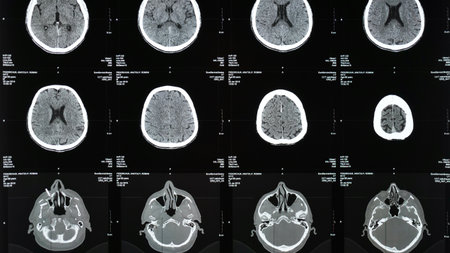 Magnetic resonance imaging of the brain from different sides, traumatic brain injury in an 60 old...