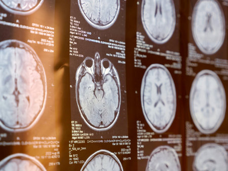 MRI of the human brain of a patient with multiple sclerosis of the initial stage. Close-up X-rayの写真素材