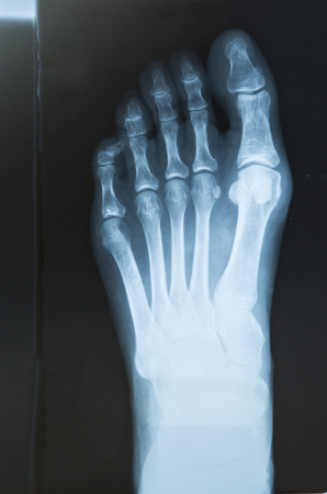X-ray of the foot with valgus breach bonesの写真素材