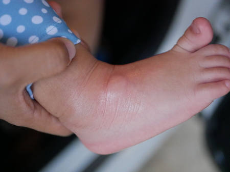 Close up of swollen ant bite on a little baby's foot