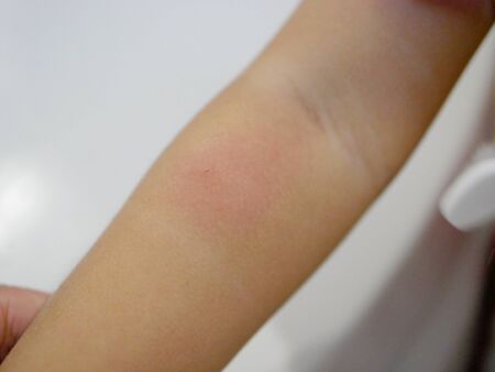 Close up of redness, itching, swelling, and wound from scratches after a mosquito bite on a little...