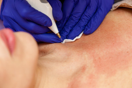 A cosmetologist in blue gloves removes papillomas on a girl's body with an electrocoagulator, cauterizing them with a high-frequency current.の写真素材