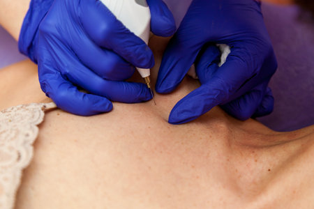 A cosmetologist in blue gloves removes papillomas on a girl's body with an electrocoagulator, cauterizing them with a high-frequency current.の写真素材