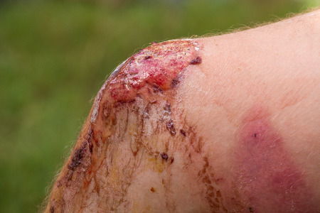 Wound on his leg man, during a traffic accident, close upの写真素材