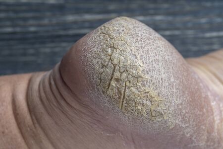 Chapped human foot heel, crack heel pictures close up. Dry and cracked skin on the heel