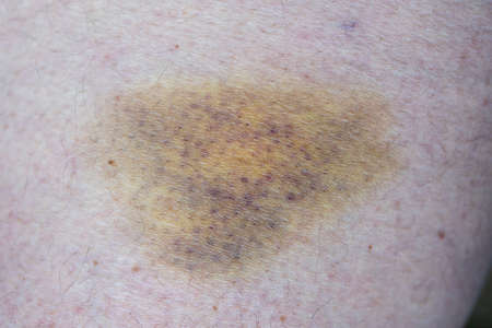 Close up bruise on wounded man leg skinの写真素材