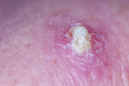 Purulent pimple on human skinの写真素材