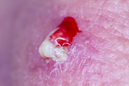 Purulent pimple on human skinの写真素材