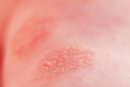 Atopic dermatitis in a childの写真素材