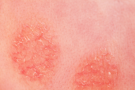 Atopic dermatitis in a childの写真素材