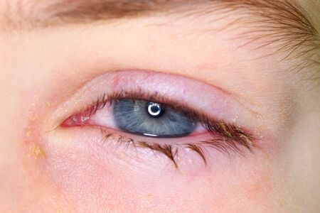 Belarus, Minsk, 2019. Conjunctivitis is a viral bacterial infection in the eye of a boy.のeditorial素材