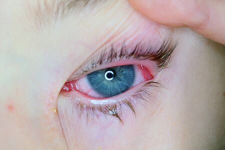 Belarus, Minsk, 2019. Conjunctivitis is a viral bacterial infection in the eye of a boy.のeditorial素材