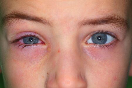 Belarus, Minsk, 2019. Conjunctivitis is a viral bacterial infection in the eye of a boy.のeditorial素材