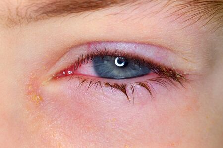 Belarus, Minsk, 2019. Conjunctivitis is a viral bacterial infection in the eye of a boy.のeditorial素材