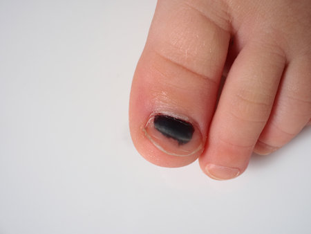 bruise on child's toe. damaged black nailの写真素材