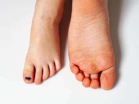 bruise on child's toe. damaged black nail