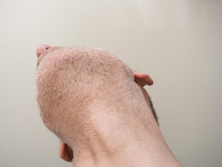 Close up of a man's face with hair loss problem on itの写真素材