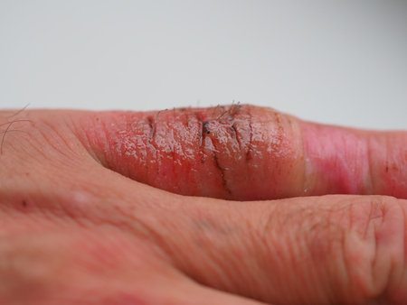 infection skin of a human finger dermatitis. psoriasis allergy eczemaの写真素材