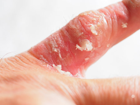 infection skin of a human finger dermatitis. psoriasis allergy eczema
