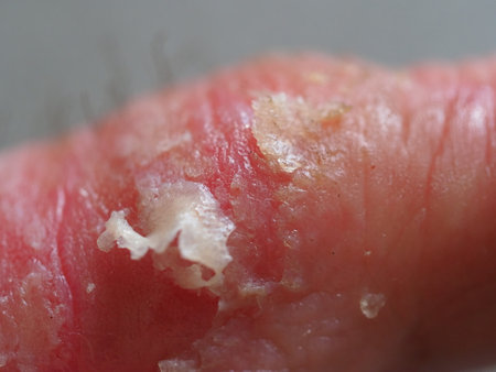 infection skin of a human finger dermatitis. psoriasis eczema