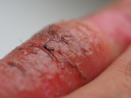 infection skin of a human finger dermatitis. psoriasis allergy eczemaの写真素材