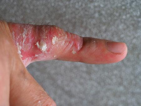 infection skin of a human finger dermatitis. psoriasis allergy eczema