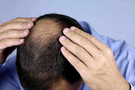 Man concerned about hair loss. Baldness, male hands on a bald