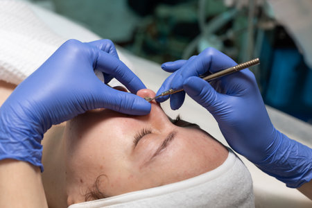 Skin treatment procedure in a clinical setting during daytime for acne careの写真素材