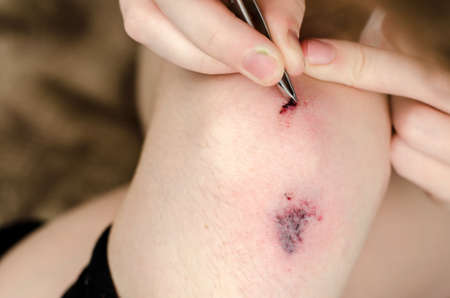 Close-up of a man's hand pulling a splinter from a wounded kneeの写真素材