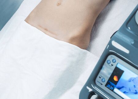 a scar on the stomach of a girl who is lying on a couch in a clinic near the laser apparatusの写真素材