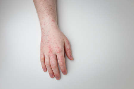 Patient showing arm and hand with red itchy painful rash. Allergic symptom on male hands. Dermatology, skin care. White background, top viewの写真素材