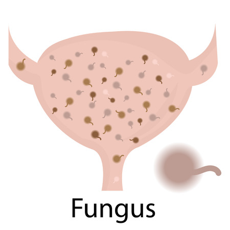 Fungus. Urinary tract infection.のイラスト素材