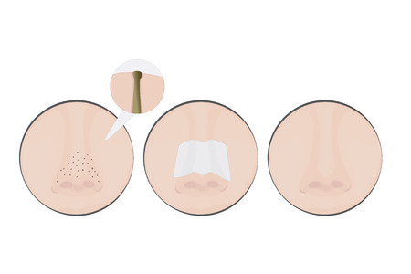 Blackheads on Nose vector illustration showing skin problemsのイラスト素材