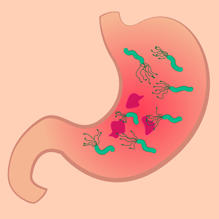 A stomach full of microbes, vector illustration.のイラスト素材