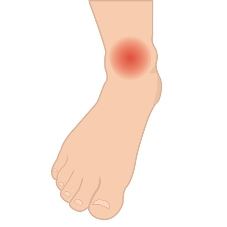 Swelling of the feet and ankles from infected or injury vector illustrationのイラスト素材