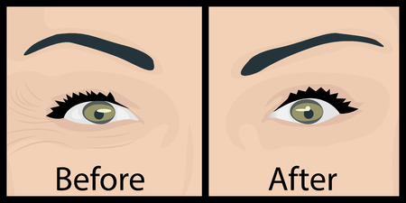 Wrinkles and fine lines around the eye with before and after treatment imageのイラスト素材