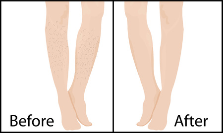 Before and after Hair removal methods and results Vector illustration.のイラスト素材