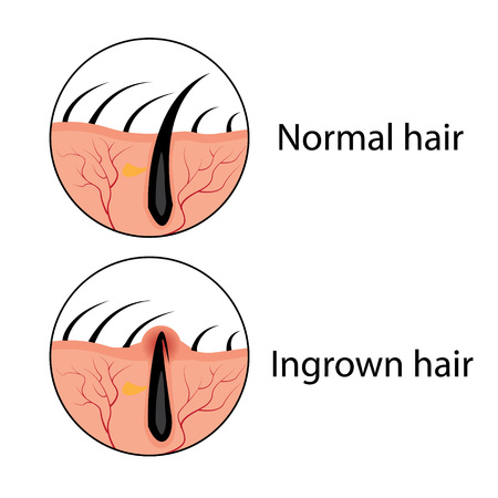 Normal and ingrown hair vector illustration. Skincare problem.のイラスト素材