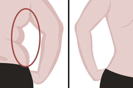 Fat and slim girl's back. Fat waist. Liposuction. Before and after. Woman body correction vector illustrationのイラスト素材