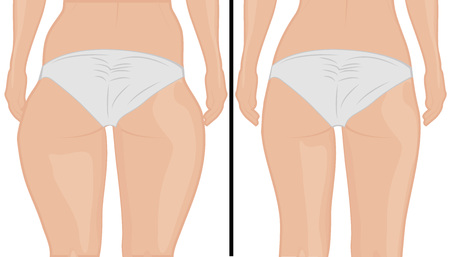 Fat and slim girl's back. Fat thig. Liposuction. Before and after. Woman body correction vector illustrationのイラスト素材