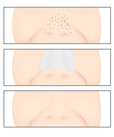 Blackheads on Nose vector illustration showing skin problemsのイラスト素材