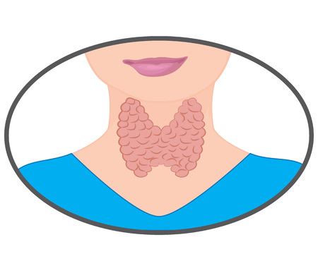 Goiter. Enlarged Thyroid. Endocrine disfunction vector illustration on a white background. Hyperthyroidismのイラスト素材