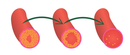 Reduce Levels of cholesterol plaque in vessels vector illustrationのイラスト素材