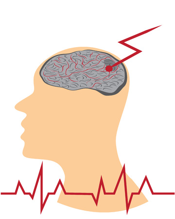 Stroke develope in human brains vecroe illustrationのイラスト素材