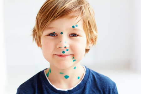 cute young boy, kid having chicken pox, that is cured with brilliant green antisepticの写真素材