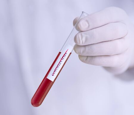 Coronavirus 2019-nCoV Sample. medical nurse holding test-tube. Epidemic diseaseの写真素材