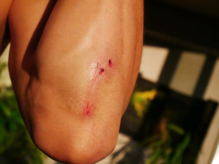 Injured man Elbow with Scrapes Against Blurred Background