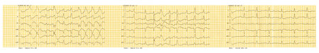 Emergency cardiology. ECG tape with paroxysm of atrial fibrillation and restoration of sinus rhythm...